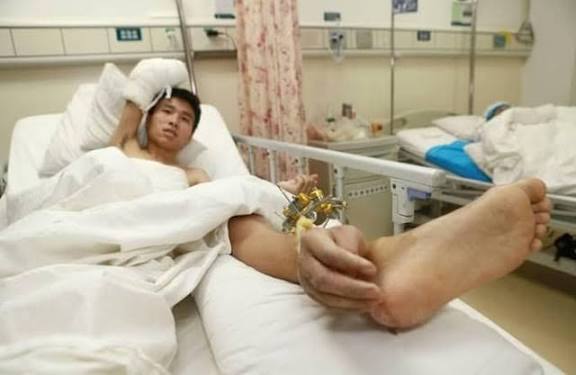 Doctors Saved a Man’s Severed Hand by Attaching It to His Ankle — Here’s How It Worked
